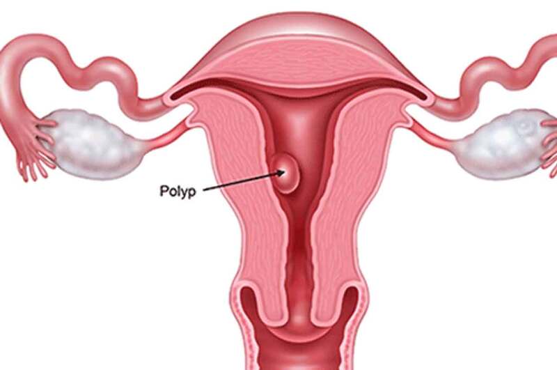 Polyp tử cung